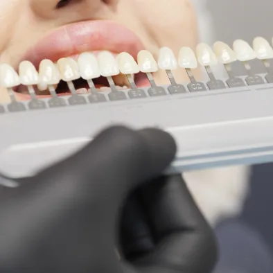 Porcelain Veneers vs. Composite Resin Veneers