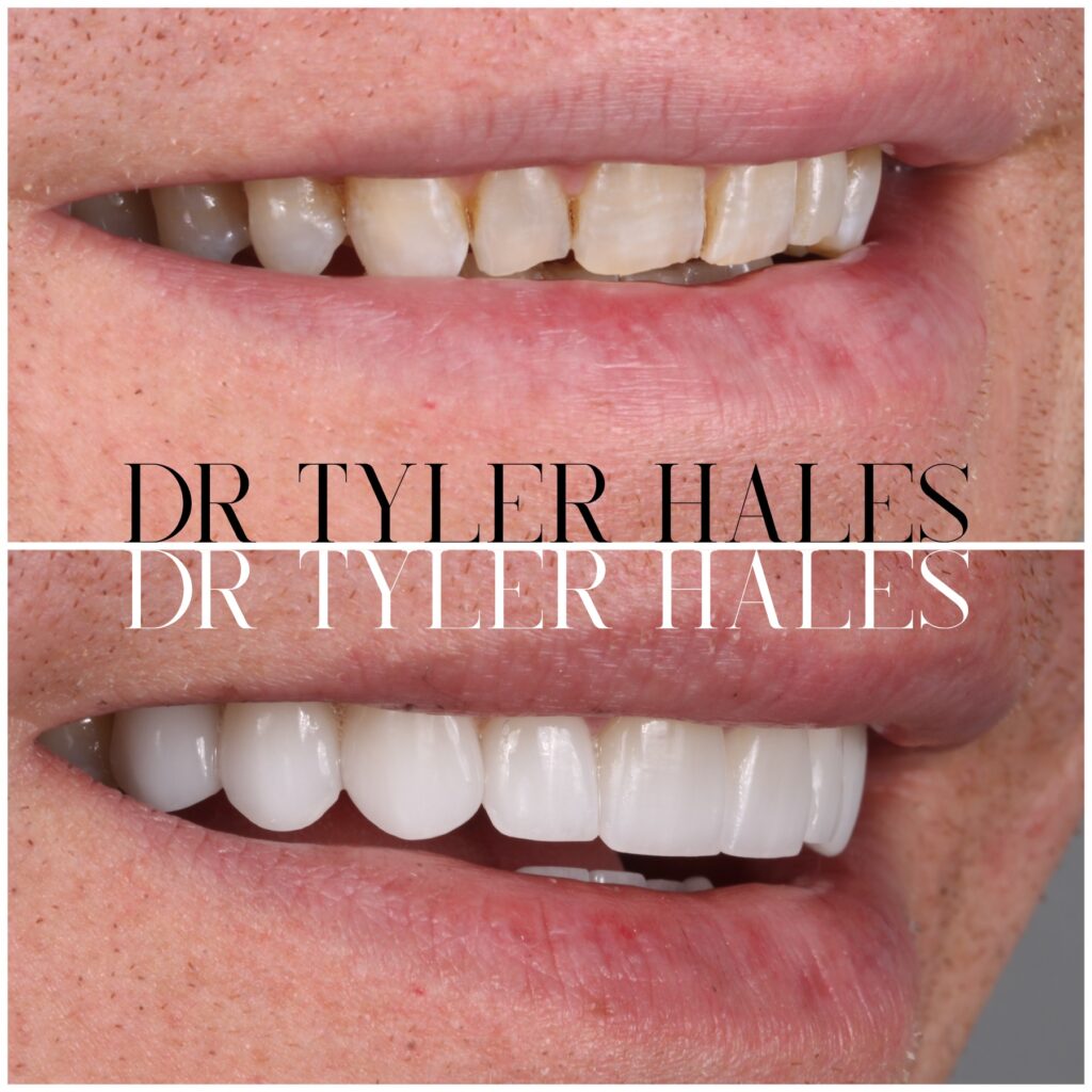 Smile Makeover with Dr. Hales