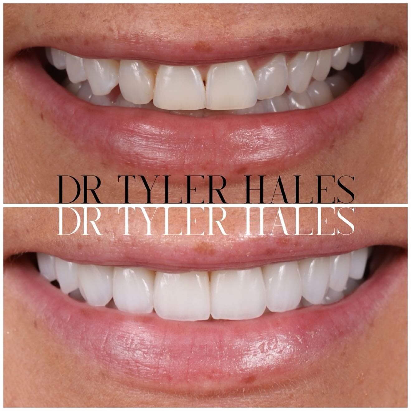Harmony Veneers