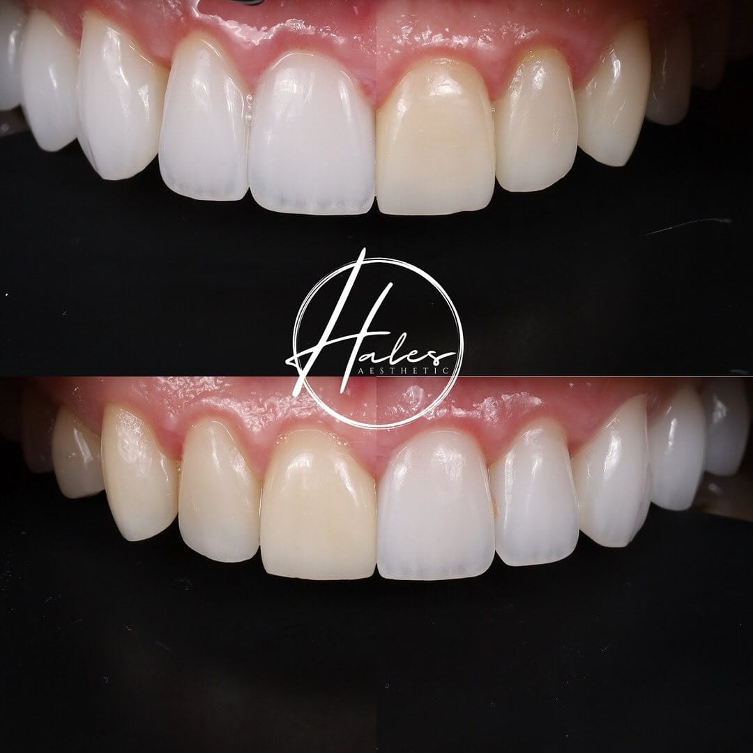 Harmony Veneers Process