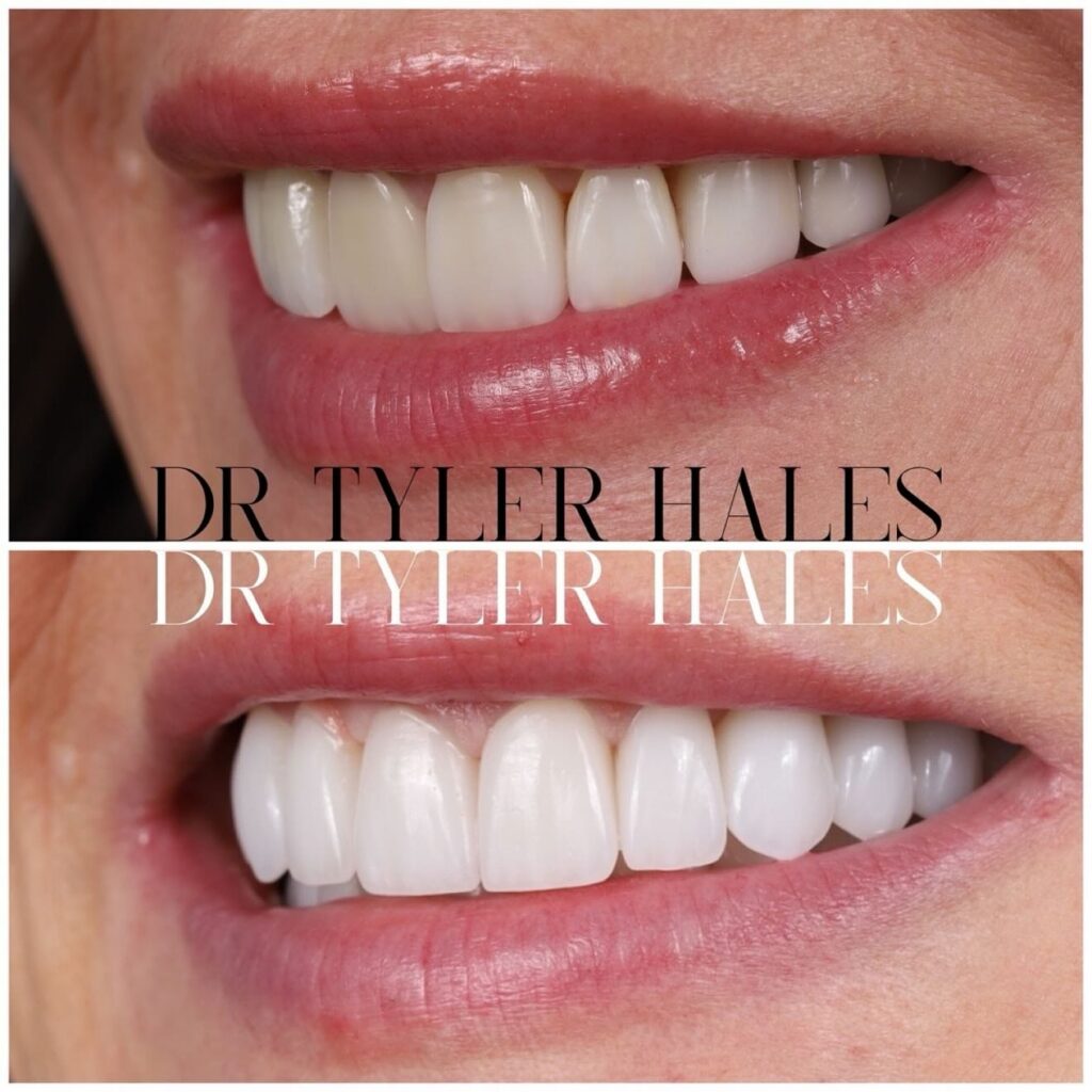 Harmony vs Porcelain Veneers