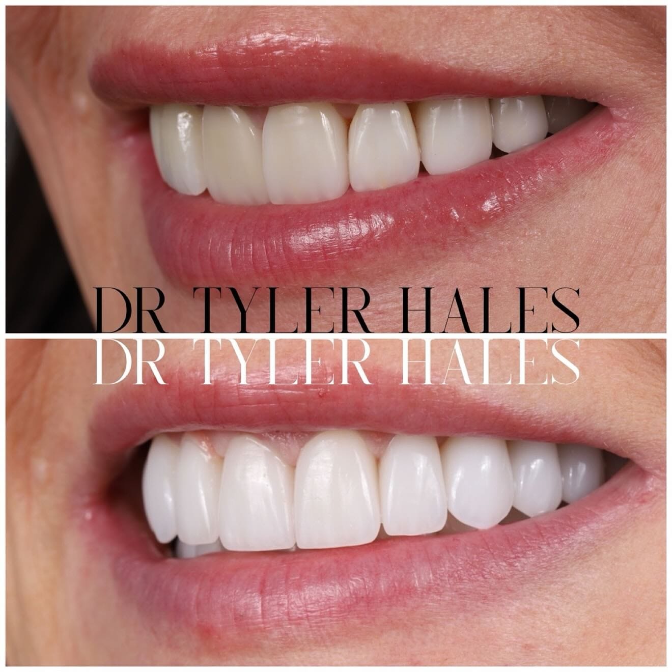 Harmony vs Porcelain Veneers