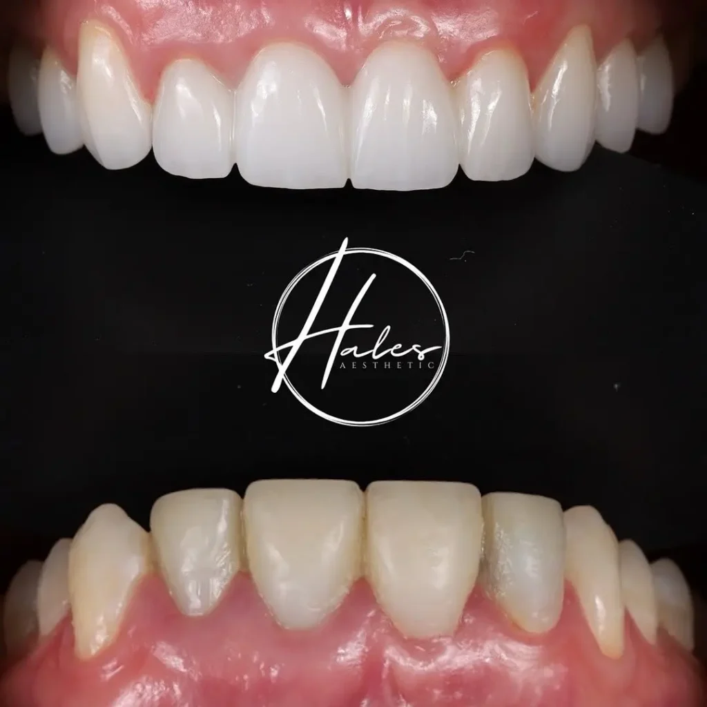 Long-lasting Porcelain Veneers