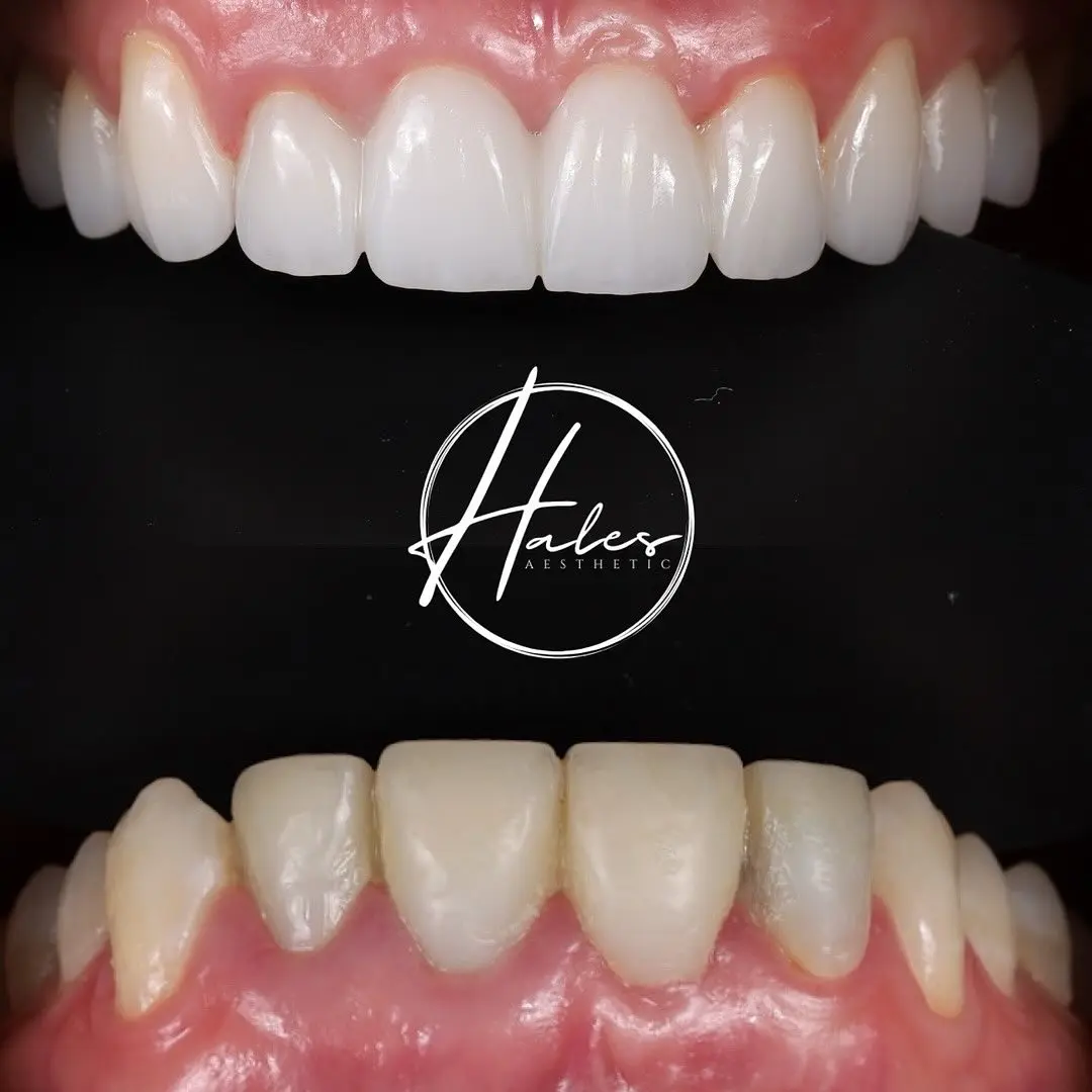 Long-lasting Porcelain Veneers