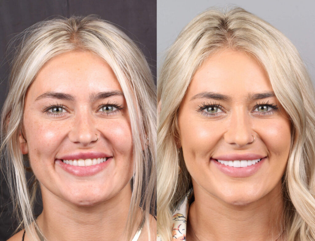 Smile Makeover