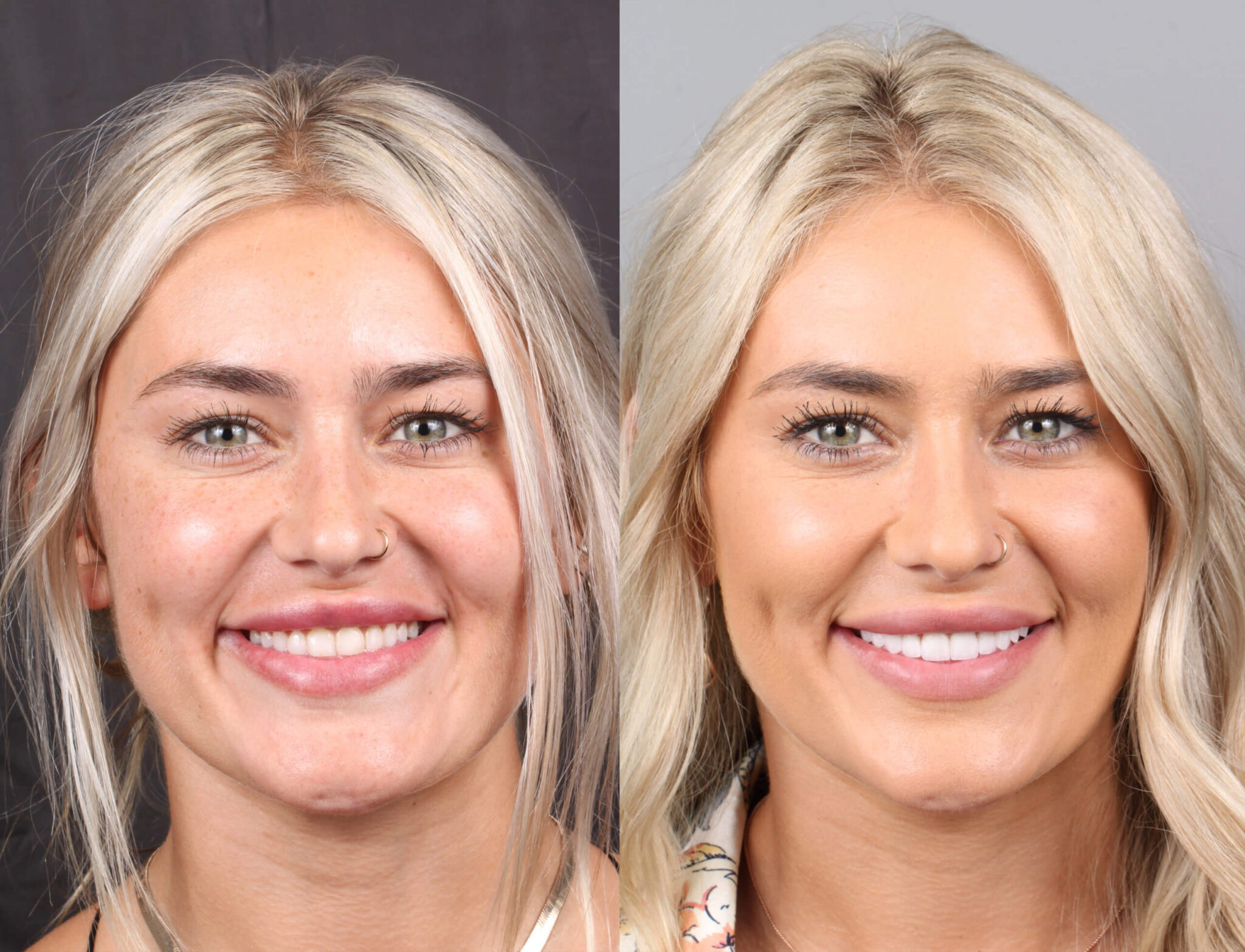 Smile Makeover