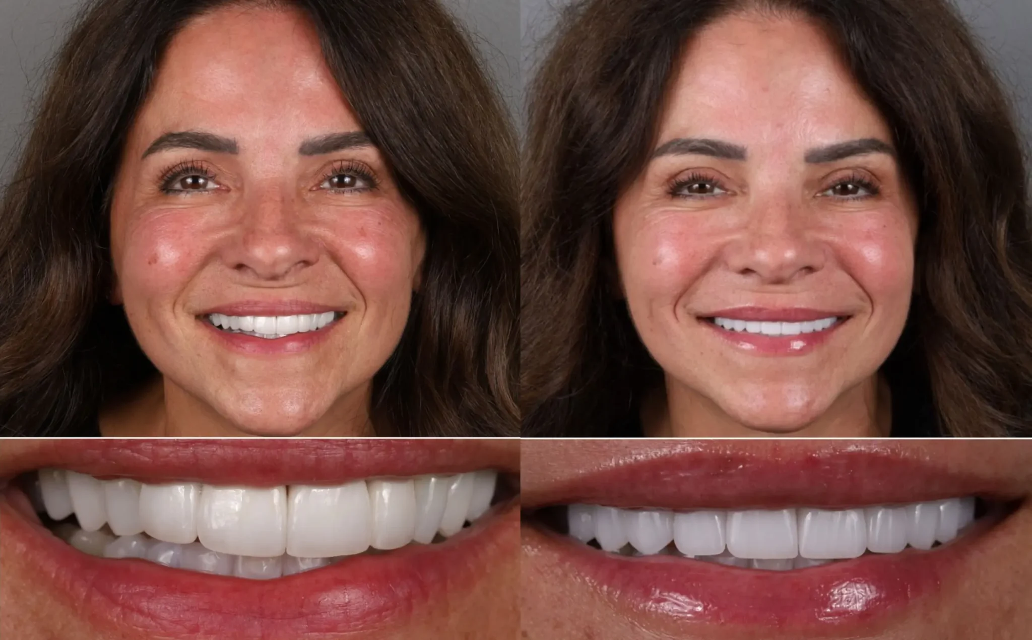 Smile Makeover