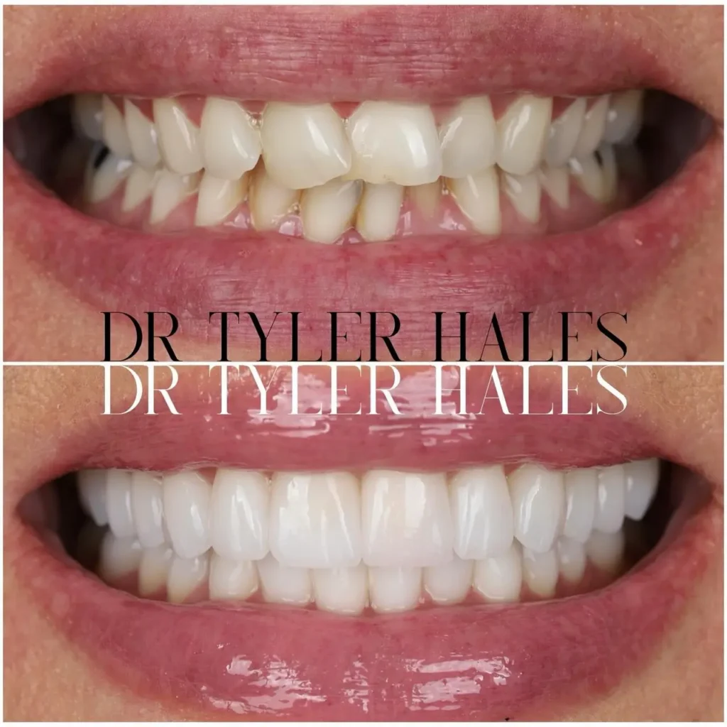 What is the difference between Harmony and Porcelain Veneers