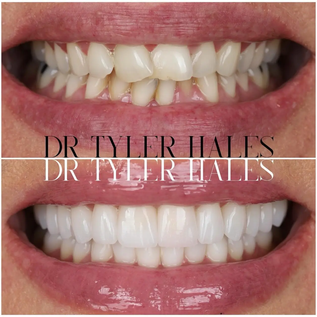 What is the difference between Harmony and Porcelain Veneers