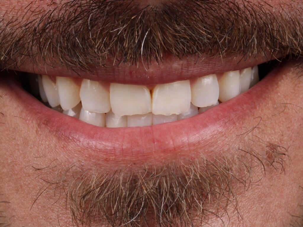 Before