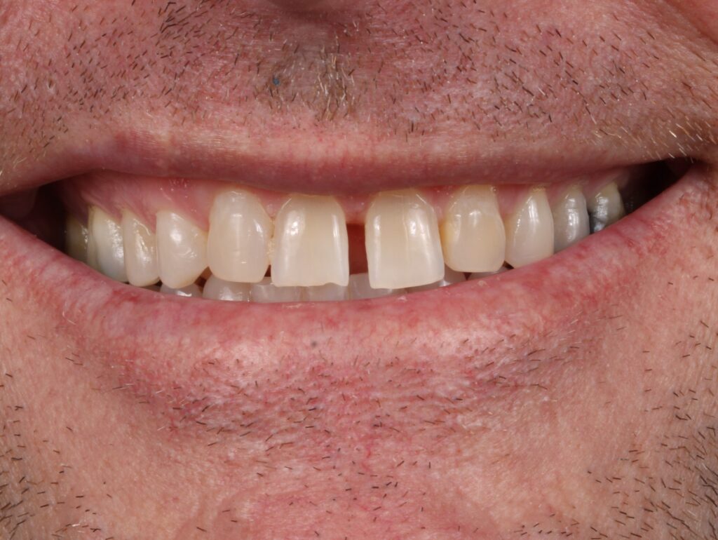 Before