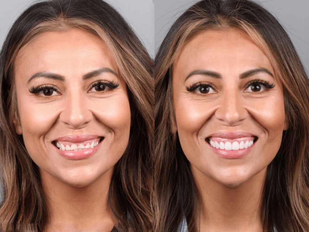Before and After Smile